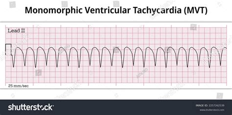 Polymorphic Ventricular Tachycardia Causes