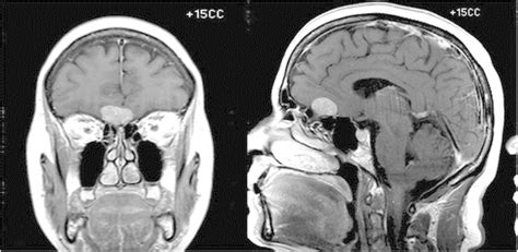 Preoperative MRI showing the 24 × 26 mm olfactory groove meningioma (OGM) | Download Scientific ...