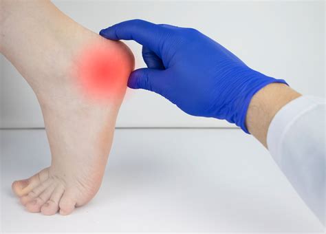 Why You Should Never Ignore Achilles Heel Painv - Suncoast Orthopaedic ...