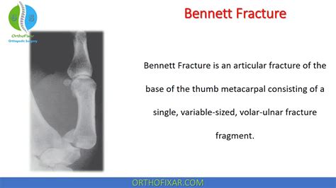 Bennett Fracture Overview | OrthoFixar 2025