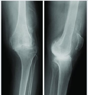 X-ray of the left knee joint shows varus deformity and large calcified ...