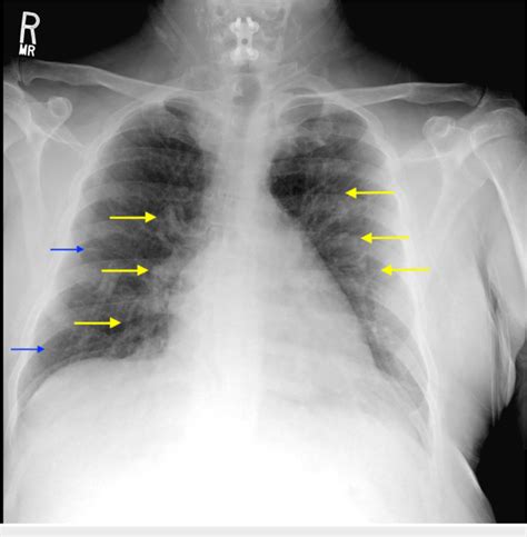 Chest X-ray of the patient The image displays the development of ...