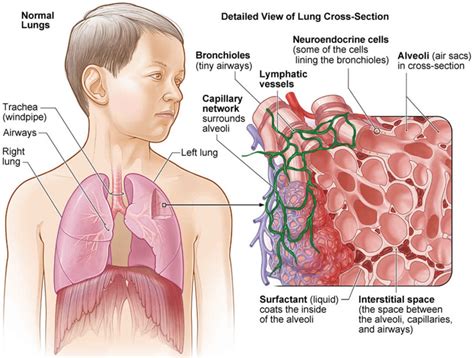 Hypersensitivity pneumonitis causes, symptoms, diagnosis, treatment & prognosis