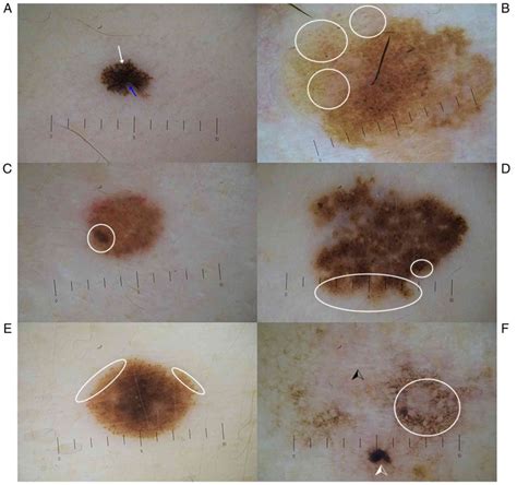 Benign Nevus Vs Melanoma