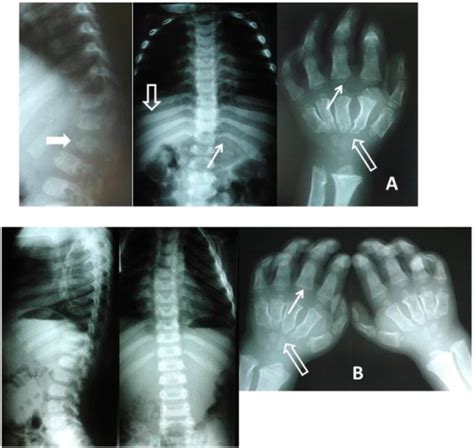 Comparative X-rays at age 6years. A — older sister of P1: note ...