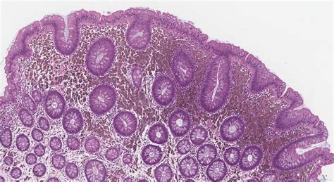 Melanosis coli | Atlas of Pathology