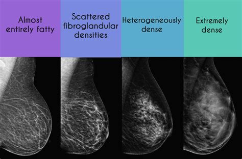 Dense Breast Tissue? What To Know | UVA Radiology