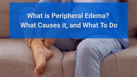 Peripheral Edema - Causes, Symptoms, and Treatments - YouTube