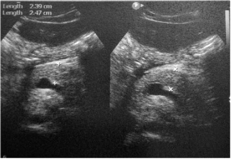 Ultrasound showing swollen pancreas. | Download Scientific Diagram