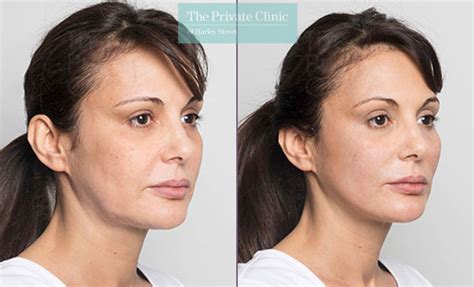 Thread Lifts UK, Facelift without Surgery, Non-Surgical Thread Face Lift, Silhouette Lift