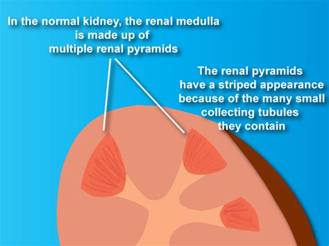 What is Medullary Sponge Kidney?