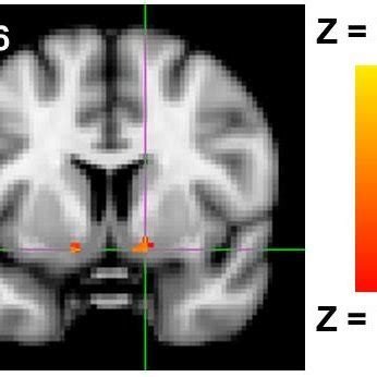 Bilateral ventral striatum activity associated with greater retaliatory... | Download Scientific ...