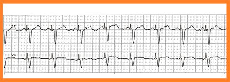 Various Ventricular Paced Rhythms