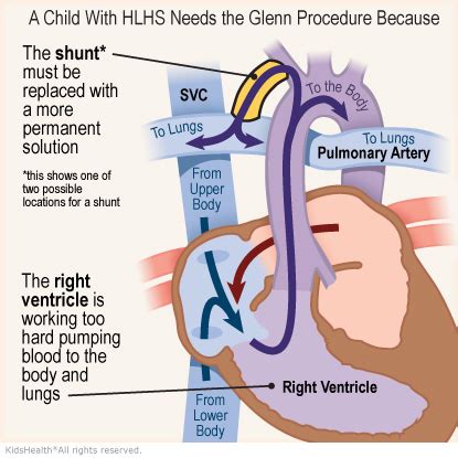 The Glenn Procedure | Rady Children's Hospital