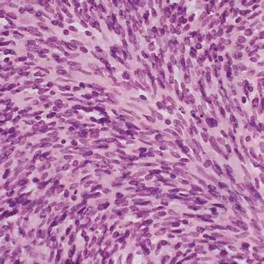 The 4 Types of Mesothelioma, Cell Types and Tailored Treatment