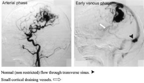 Cerebral angiogram dated 1994. A moderately sized arteriovenous... | Download Scientific Diagram