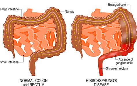 Hirschsprung's disease - Pathophysiology - TeachMePaediatrics