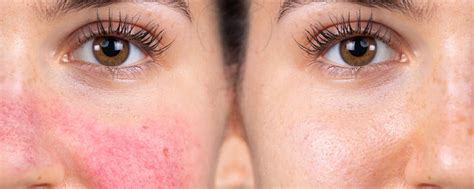 Rosacea Vs Lupus Butterfly Rash