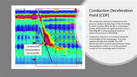 High resolution oesophageal manometry - Part 4 - Interpretation of ...