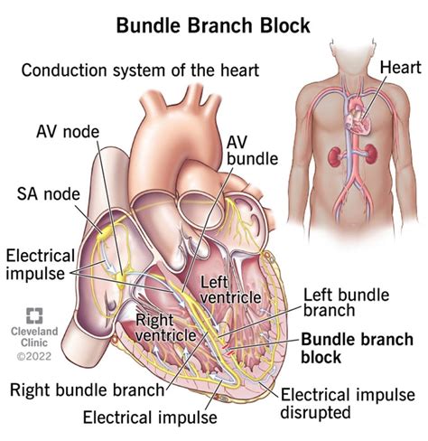 Bundle Branch Block: Causes, Symptoms & Treatment