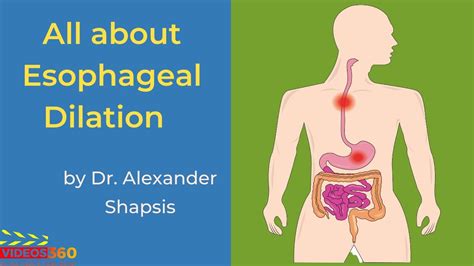 Esophageal Dilation at Atlantic Gastroenterology - Dr. Alexander ...