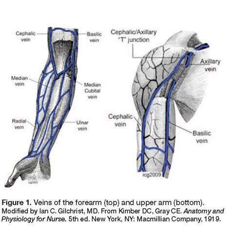 Forearm Vein Access for Radial Procedures: An Easy Method for Right and ...