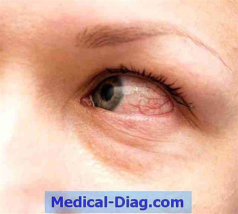 Allergische Konjunktivitis: Symptome, Ursachen Und Behandlungen (Medical-Diag.com 2024)