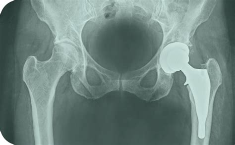 Ceramic Hip Replacements in West Sussex | Mr Nirav Shah