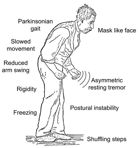 Parkinson Disease Treatment