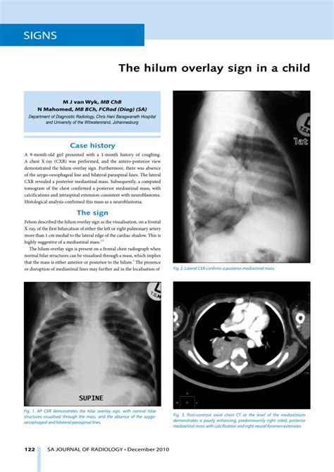 (PDF) The hilum overlay sign in a child