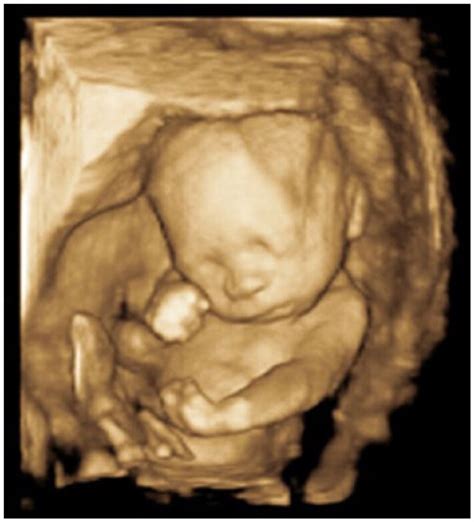 Prenatal Sonographic Detection of Multiple Congenital Anomalies: A Case of Severe Arthrogryposis ...