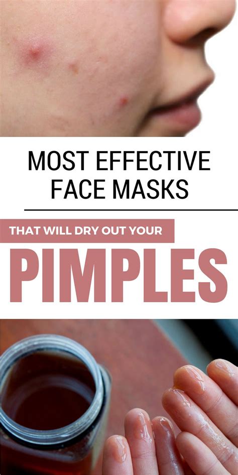 Most Effective Face Masks That Will Dry Out Your Pimples | Natural skin care remedies, Skin care ...