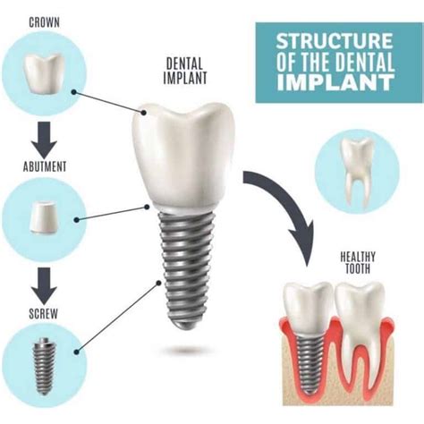 Dental Implants - Mobile Alabama Dentist | Dr. Brandon O'Donnell, DMD ...