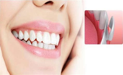 How To Find Best Dentist For Veneers In Turkey