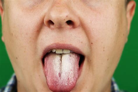 Oral Thrush: Home Remedies, Causes, Symptoms & More - Ask the Dentist