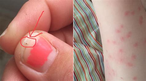 Mom shares terrifying photos of 3-year-old covered in "seed ticks" - CBS News