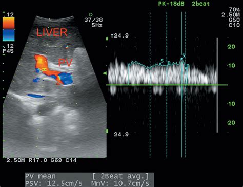 Doppler in Portal Hypertension | Radiology Key