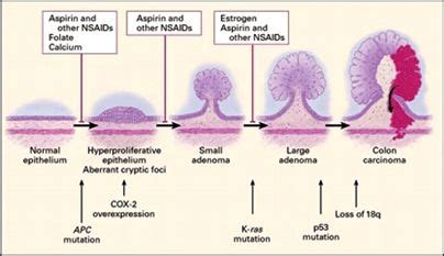 The 7 best colon polyp images on Pinterest | Med school, Medical and Polyps symptoms