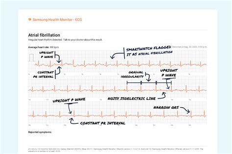 Sinus Arrhythmia Vs. Premature Atrial Contraction (Multiple) on Your Watch ECG | Qaly