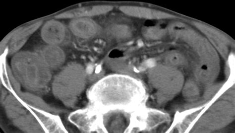 CT Diagnosis of Acute Mesenteric Ischemia from Various Causes | AJR