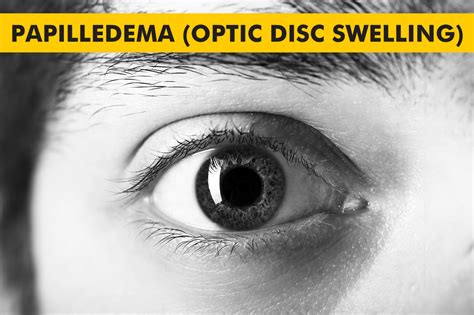 Papilledema (Optic Disc Swelling) - Symptoms, Causes and Treatment | Centre for Sight