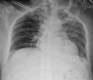 Needle Thoracostomy Location, Indications, Procedure | Needle ...