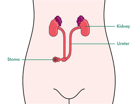 Urostomy – Ileal Conduit – The Australian Council of Stoma Associations Inc