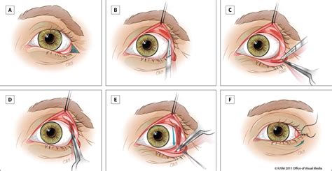 Single-Stage Repair of Paralytic Ectropion Using a Novel Modification of the Tarsoconjunctival ...
