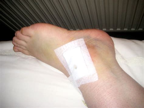 ANKLE ARTHROSCOPY RECOVERY | ANKLE ARTHROSCOPY RECOVERY