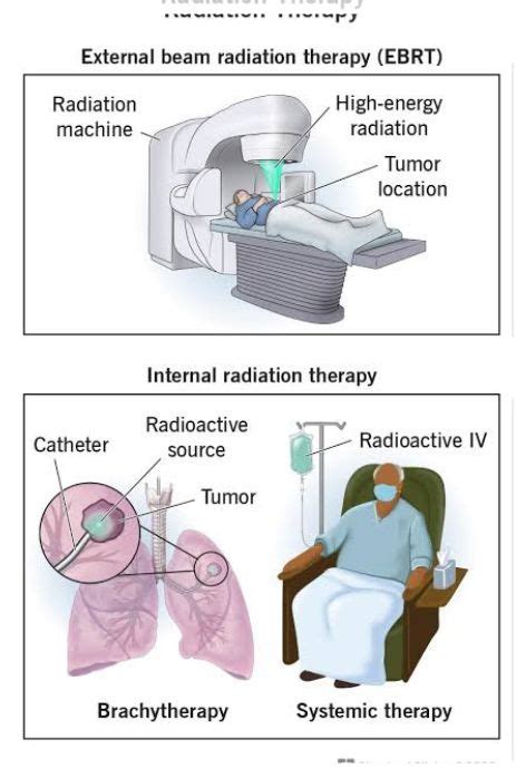 Radiation Therapy: Types, Purpose, Side Effects, and More - Engiomed