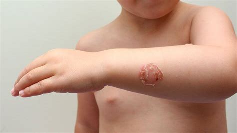 Impetigo: Symptoms, Diagnosis, Treatment, and More