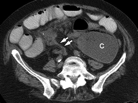 Findings of Cecal Volvulus at CT | Radiology