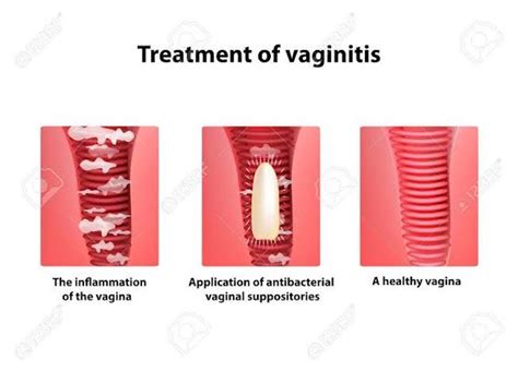 VAGINITIS (INFLAMMATION OF THE VAGINA) PART 3 – THISDAYLIVE