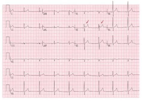 Preoperative electrocardiogram (ECG) of the patient. The ECG shows the... | Download Scientific ...